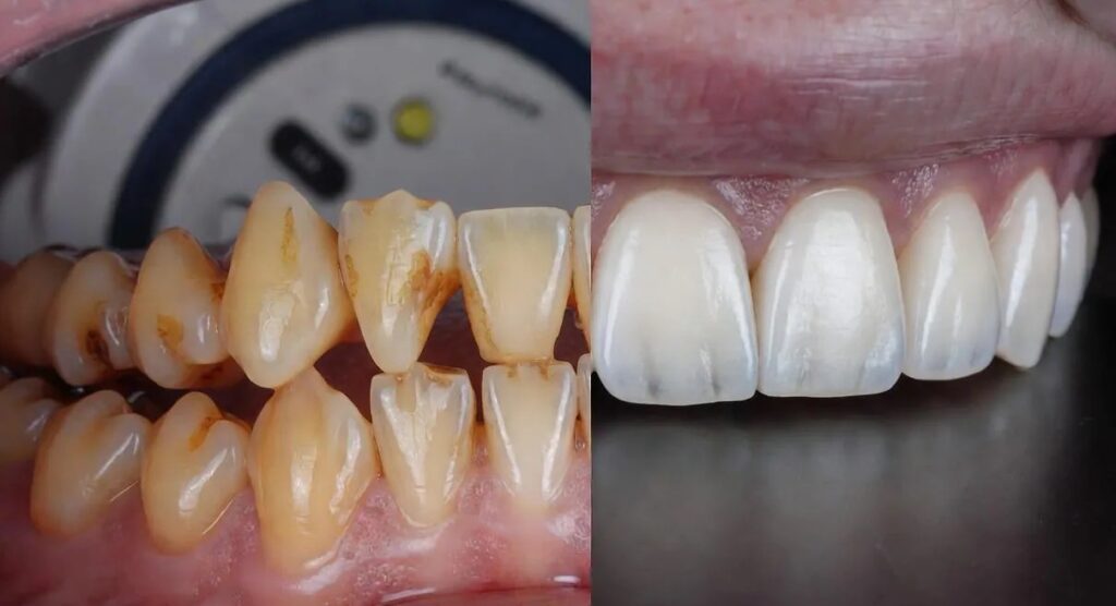 Cosmetic teeth bonding procedure improving chipped front tooth