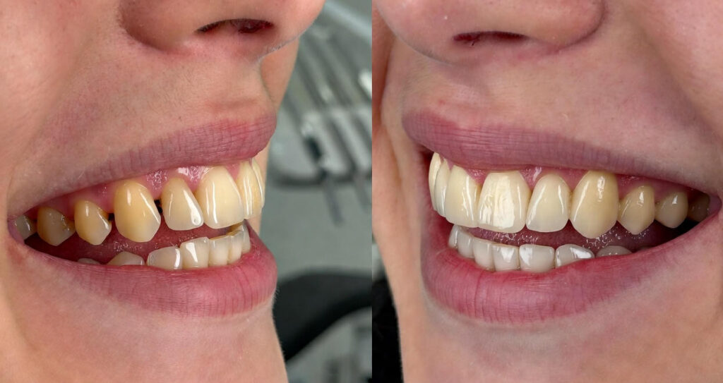 Before and after view of a patient’s front teeth